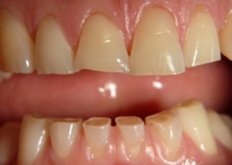 سایش دندانها