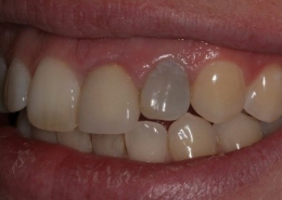 دلایل سیاه شدن دندان ها