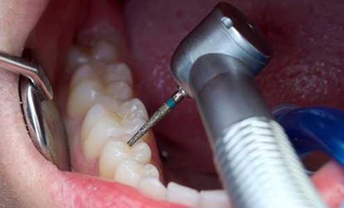 عصب کشی دندان در تهران