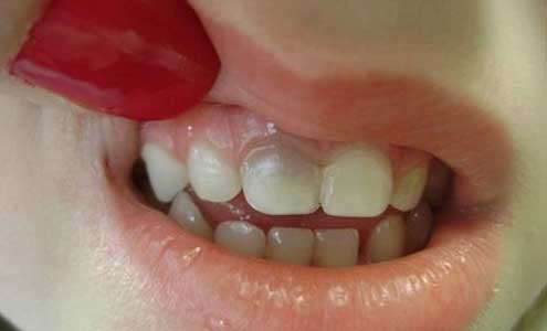 تغییر رنگ دندان در نوزادان