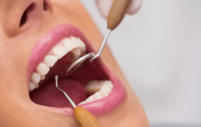 کامپوزیت دندان در نواب