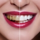 آیا سفید کردن دندانها یا بلیچینگ واقعا موثر است. بله. ثابت شده که این مهم برای دندان ها بی خطر و موثر می باشد. سفید کردن دندانها به شکل رایج در حدود ۱۰ سال است که انجام می شود.