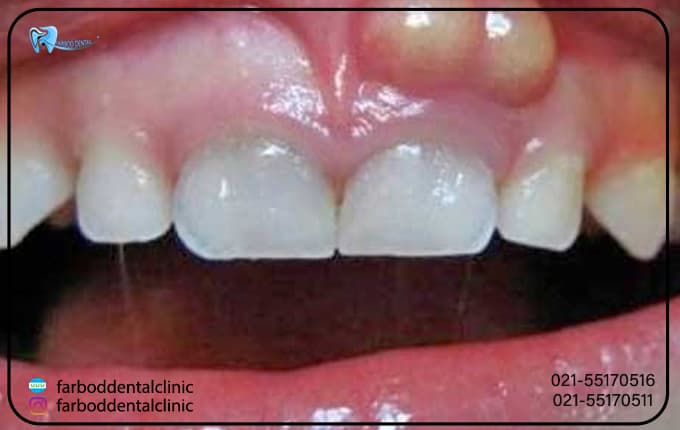 مراحل درمان آبسه دندان