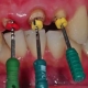 عصب کشی دندان در تهران