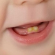 تغییر رنگ دندان در نوزادان