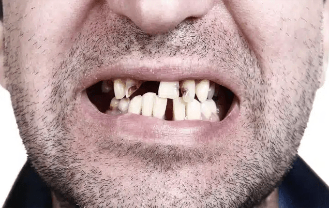 تاثیر مصرف مشروبات الکلی بر سلامت دندان