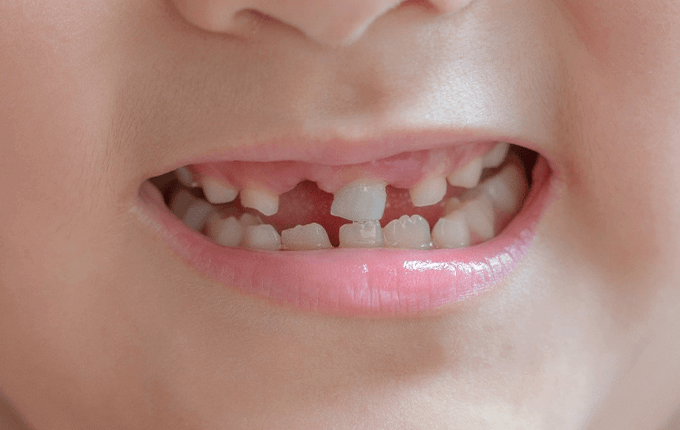  درمان شکستگی دندان کودک