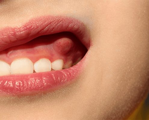 دلایل آبسه دندان کودکان