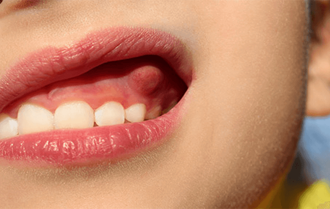 دلایل آبسه دندان کودک چیست؟ 