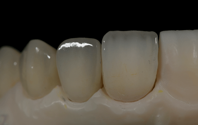 کامپوزیت دندان به روش لیرینگ