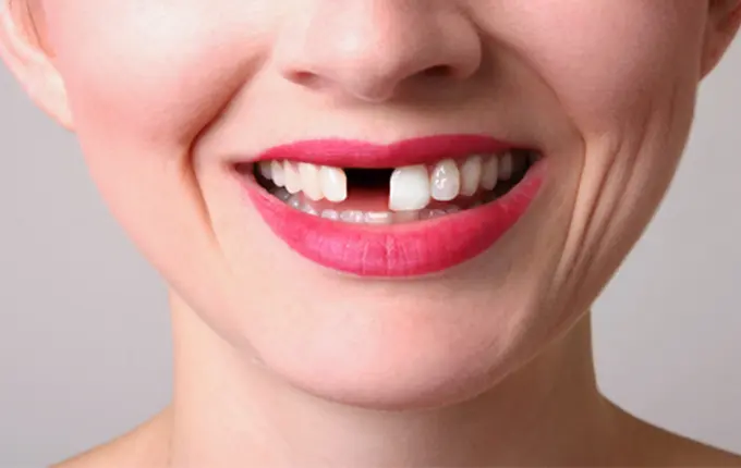 6 علت لق شدن دندان دائمی 