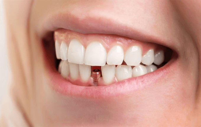 6 علت لق شدن دندان دائمی 
