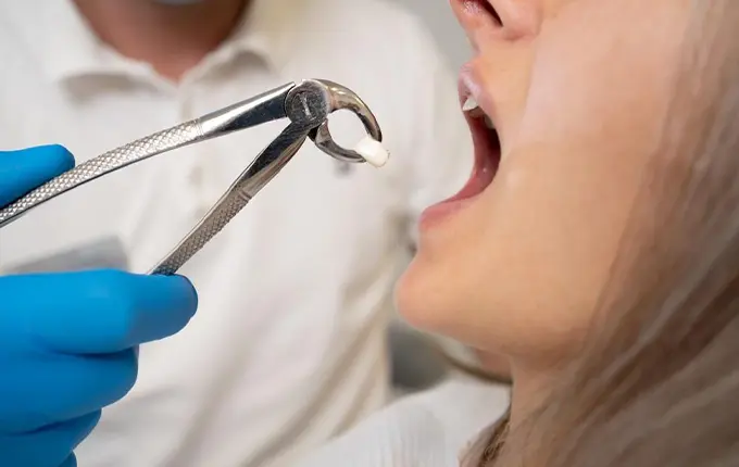 آیا بیمه هزینه کشیدن دندان را پوشش می دهد؟