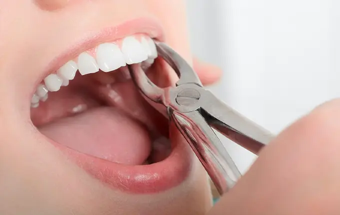 عوامل موثر بر هزینه کشیدن دندان در تهران 