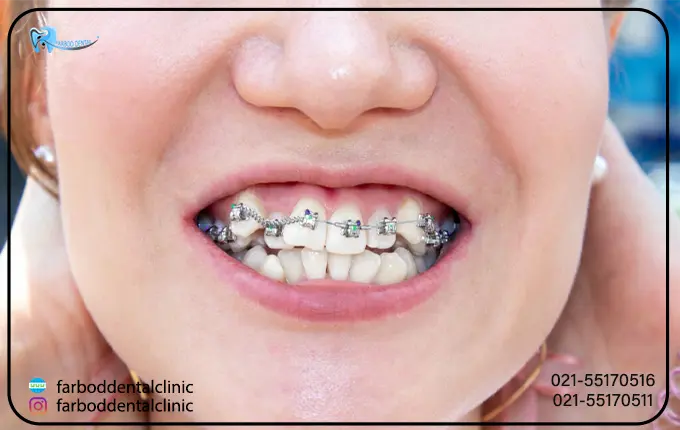 روش های درمان دندان های کج